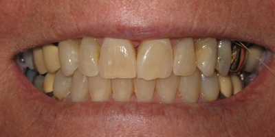roderick_russell-restorations-receding-gums-discolored-teeth-before